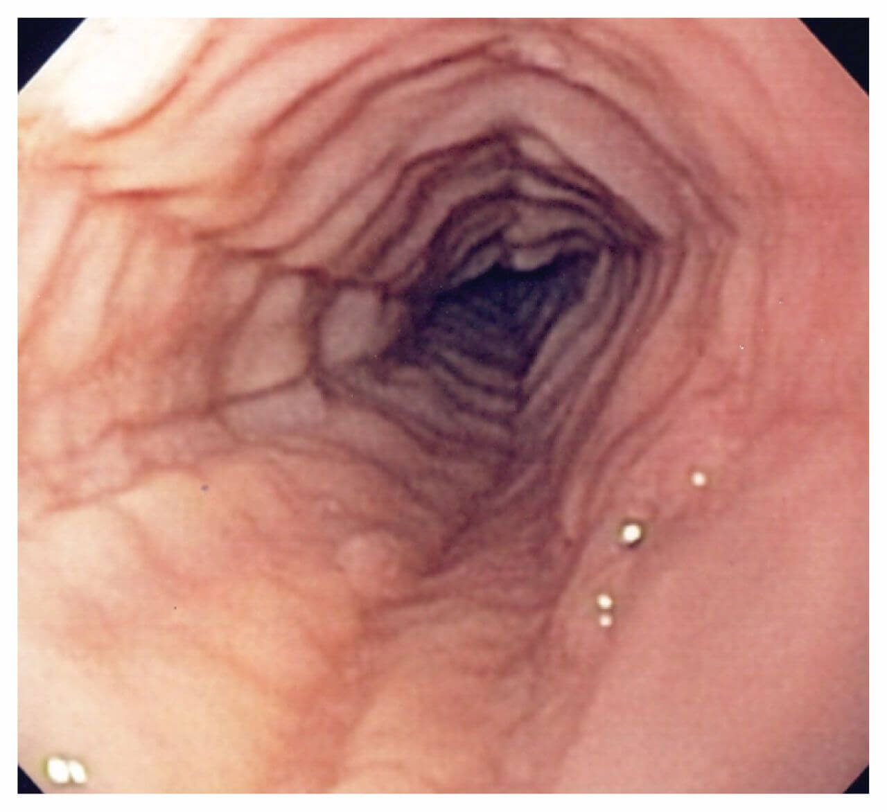 Eozinofilni-ezofagitis